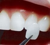 licówki czyli białe zęby